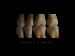Full Zirconia Ceramic Dentures High Precision Digital Production For Functional Restoration