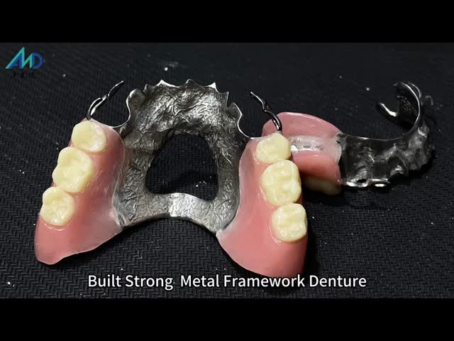 Custom Cast Partial Denture Natural Looking Solution For Enhanced Comfort And Speech