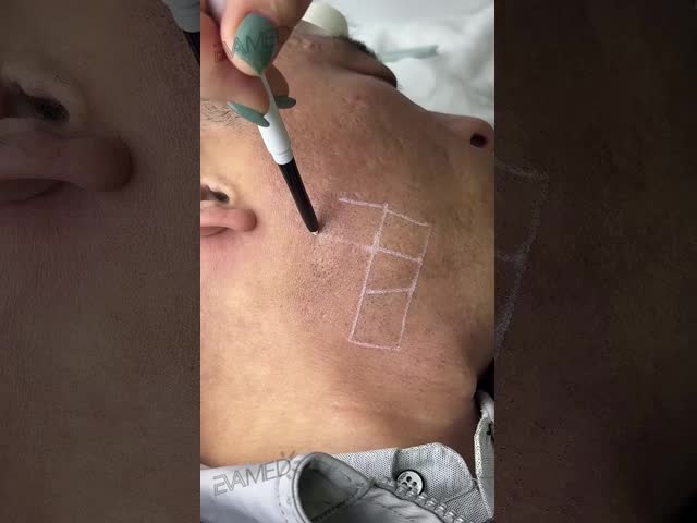 Pigment Lesions Removal Lasering 755 1064nm Alex Long Pulse Shorter Pulse Alexandrite Yag Lasering Hair Removal Machine
