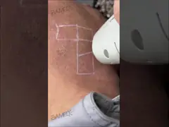 755nm 1604nm Nd Yag Alexandrite lunghe pulsazioni Laser depilazione macchina