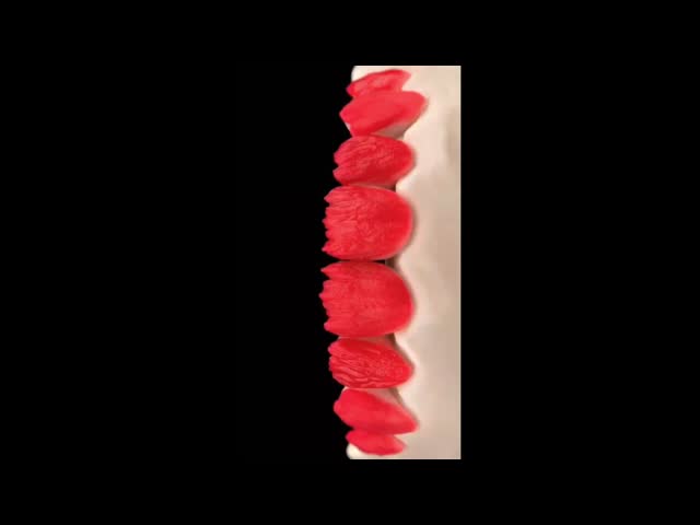 Porcelain Emax Veneers With Cast Porcelain Ultra Thin Handmade Porcelain Stacking