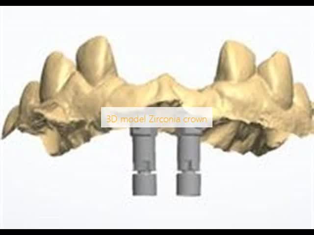 Natural-looking Zirconia Dental Crown with Excellent Biocompatibility and Cementable 3D Model