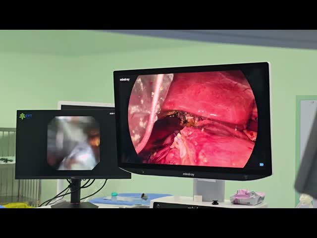 Disposable Cholangioscope Endoscope Smart Suction For Safe Biliary Procedures