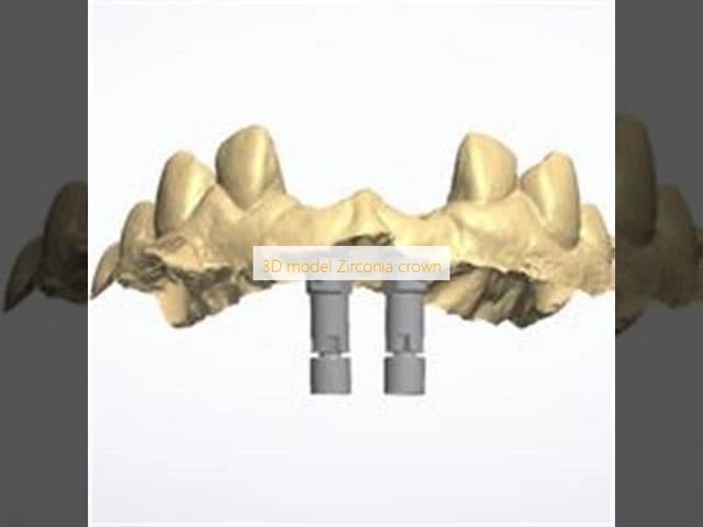 3D model Zirconia crown