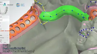 White And Pink Peek Flexible Acrylic Partial Denture With Excellent Resistance