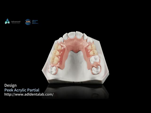 White And Pink Peek Flexible Acrylic Partial Denture With Excellent Resistance