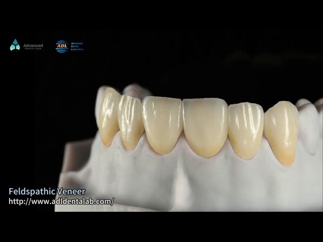 0.3mm-0.7mm Feldspathic EMAX Ceramic Veneers Natural Aesthetic Emax Dental Veneers
