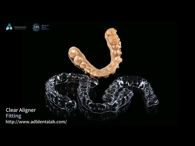 Customizable Invisible Aligner Clear Aligner With Shorter Treatment Time