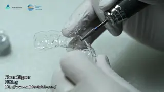 Customizable Invisible Aligner Clear Aligner With Shorter Treatment Time