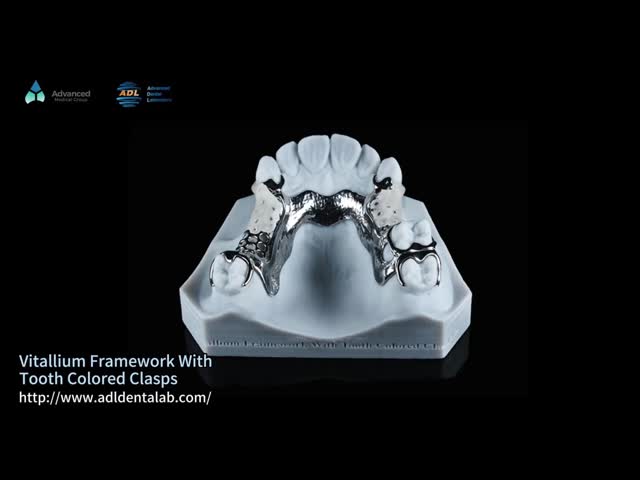 FDA Vitallium Framework With Tooth Colored Clasps For Natural Esthetics