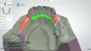 FDA Vitallium Framework With Tooth Colored Clasps For Natural Esthetics