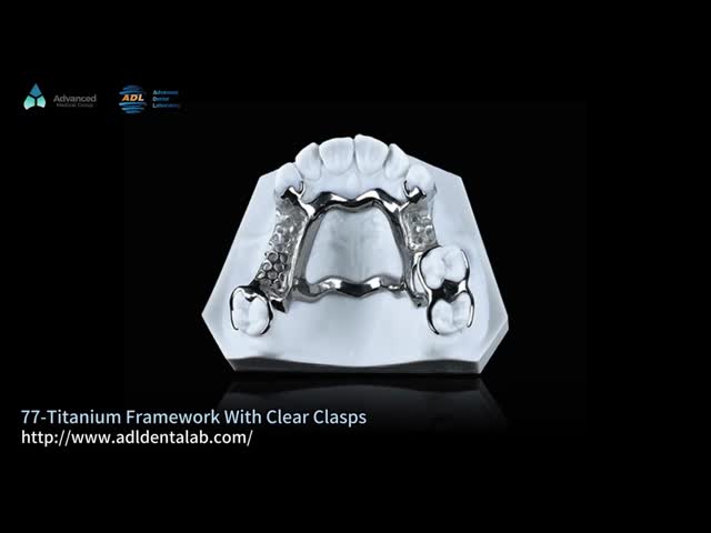 High Strength 3D Printed Titanium Framework With Clear Clasps For Durable Performance