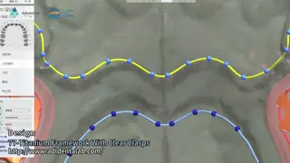 High Strength 3D Printed Titanium Framework With Clear Clasps For Durable Performance