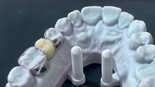 China Cast Partial Denture Framework supplier